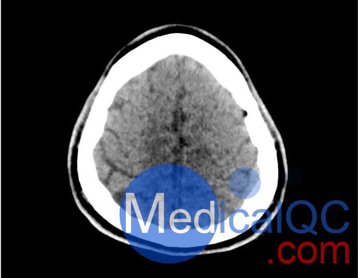50-01頭部CT模體，50-01腦中風(fēng)頭部模體，50-01腦出血頭部模體