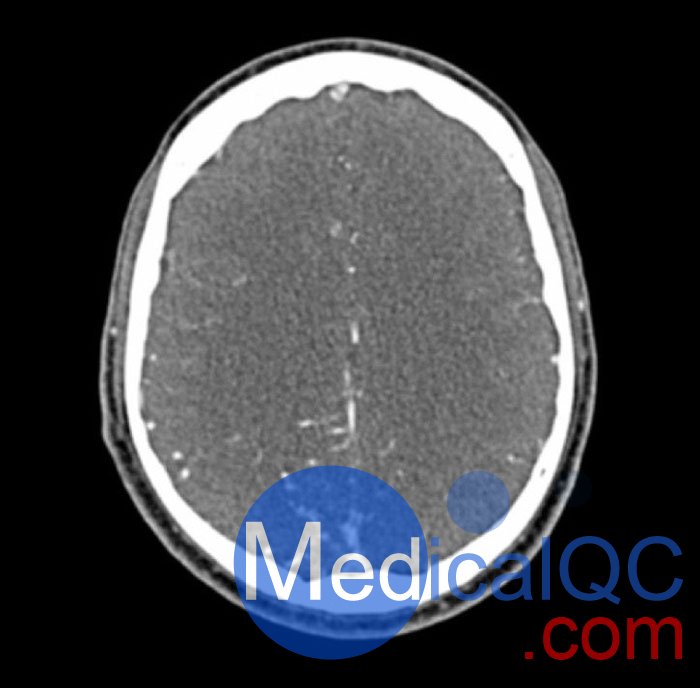 WEK50-04 CTA頭模，帶AVM CTA頭模，WEK50-04 CT血管造影頭模成像效果圖