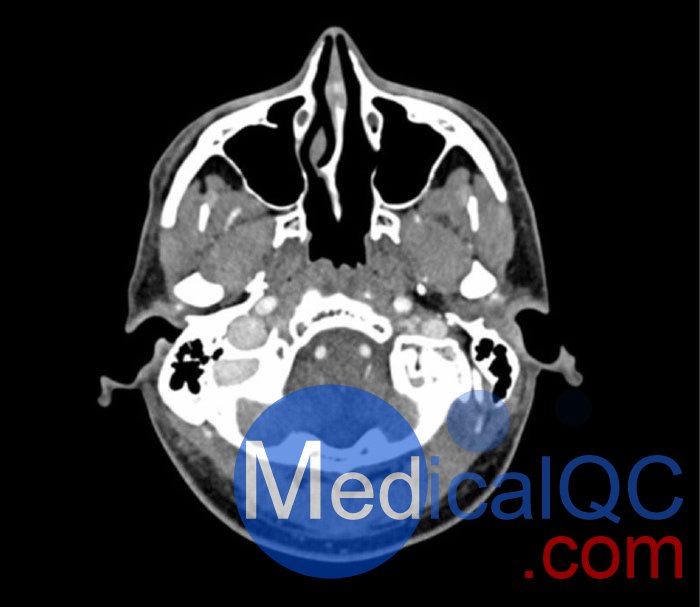 WEK50-04 CTA頭模，帶AVM CTA頭模，WEK50-04 CT血管造影頭模成像效果圖
