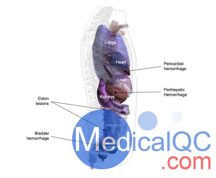 US-A04 FAST訓(xùn)練軀干模體，US-A04超聲軀干模體
