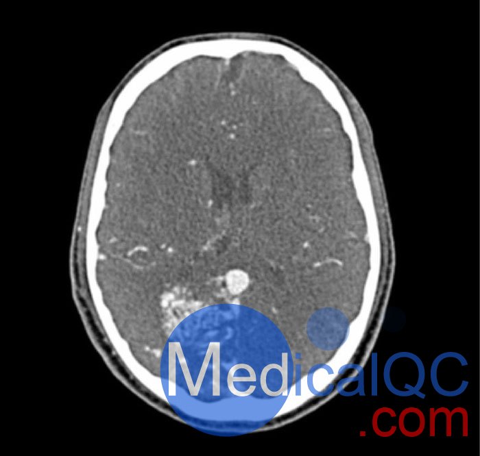 WEK-5005腦血管造影頭模，WEK-5005頭模， CTA AVM頭模成像效果圖