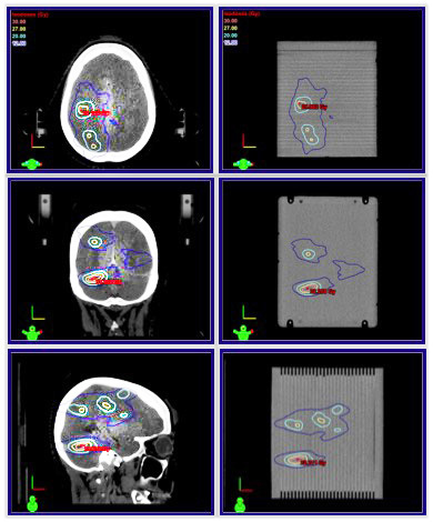 Cirs 037多病變腦QA模型，Cirs 037多病灶SRS治療計劃QA模體